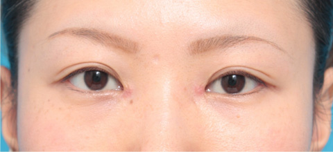 症例写真,目頭切開の症例 蒙古襞が発達して目と目が離れていた20代女性,1週間後,mainpic_megashira02c.jpg