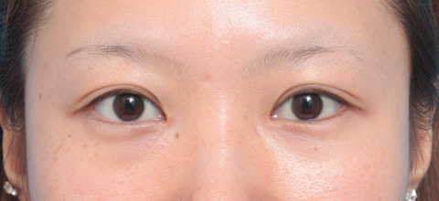 症例写真,目頭切開の症例 蒙古襞が発達して目と目が離れていた20代女性,1ヶ月後,メイクなし,mainpic_megashira02d.jpg