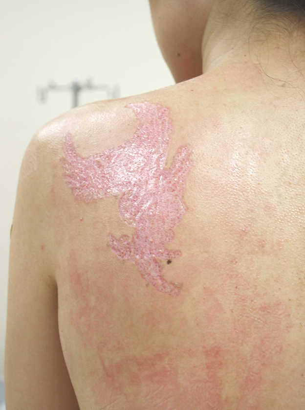 症例写真,背中の大きな入れ墨（刺青）を剥削手術で1回で除去した症例写真,1週間後,mainpic_irezumi20c.jpg