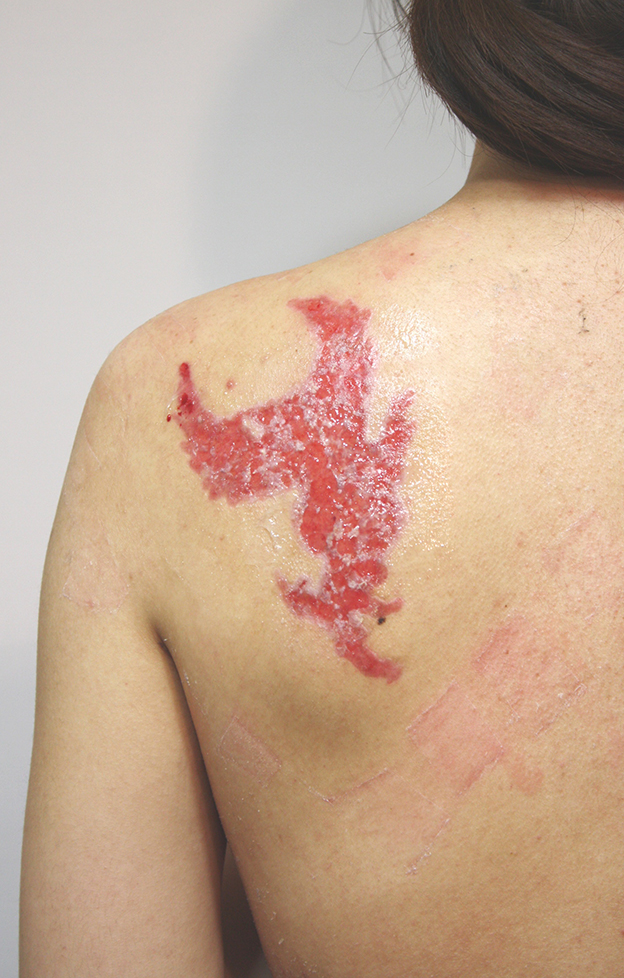 症例写真,背中の大きな入れ墨（刺青）を剥削手術で1回で除去した症例写真,3週間後,mainpic_irezumi20d.jpg