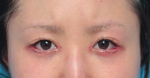 症例写真,目頭切開+目尻切開+タレ目形成で目を一回り大きくした症例写真,1週間後,mainpic_megashira05c.jpg