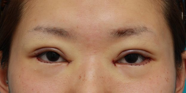 症例写真,目頭切開+目尻切開+タレ目形成+眼瞼下垂手術で目を一周り大きくした症例写真,手術直後,mainpic_megashira06b.jpg