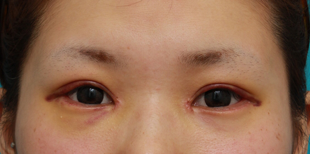 症例写真,目頭切開+目尻切開+タレ目形成+眼瞼下垂手術で目を一周り大きくした症例写真,1週間後,mainpic_megashira06c.jpg