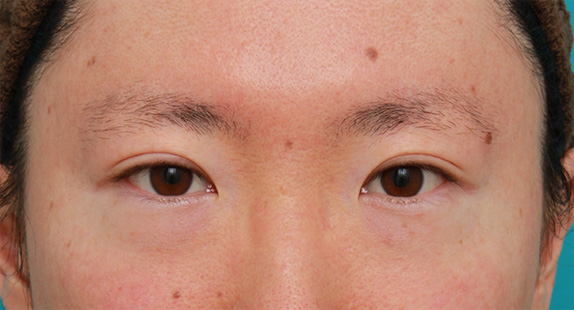 男性患者様に行った目頭切開Z法の症例写真,Before,ba_megashira24_b.jpg