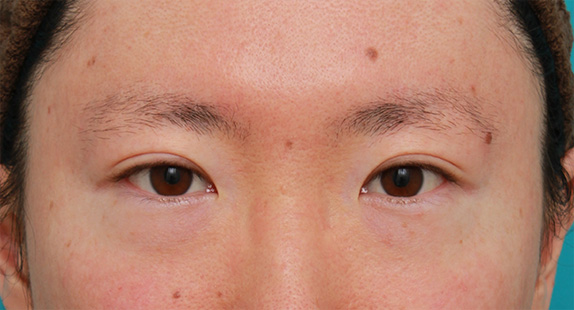 男性患者様に行った目頭切開Z法の症例写真,Before,ba_megashira24_b.jpg