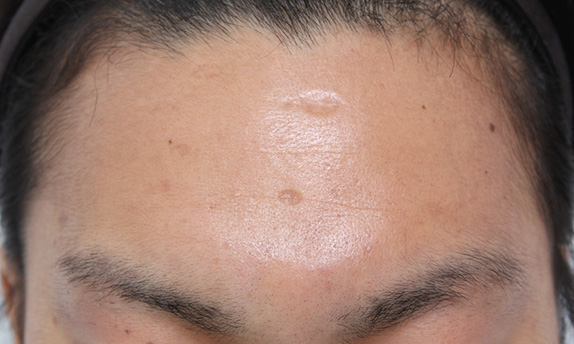 ニキビ跡、水ぼうそう跡の修正手術の症例写真,Before,ba_keisei16_b.jpg