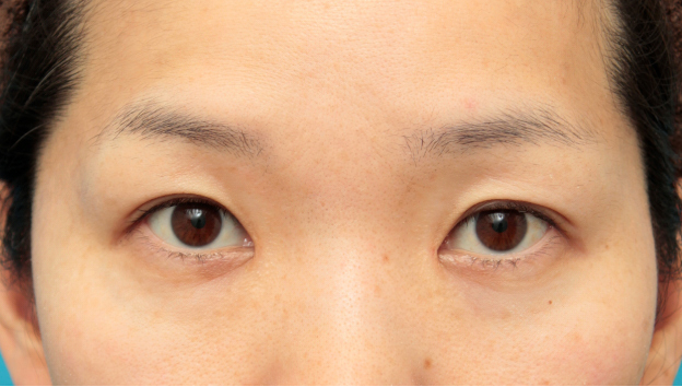 症例写真,目頭切開+二重まぶたミニ切開法で末広型二重を作った症例写真,1ヶ月後,目を開けた状態,mainpic_megashira28f.jpg