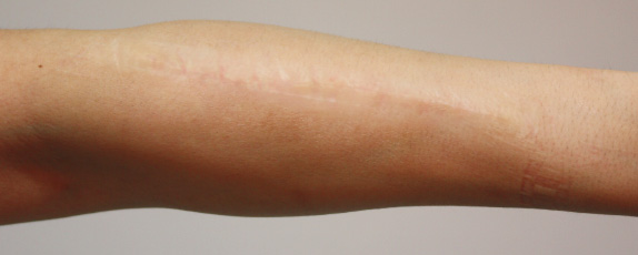 リストカットの傷跡を手術にて修正した症例写真,After,ba_keisei13_a01.jpg