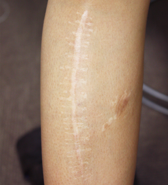 傷跡の症例写真　脚の傷跡を手術で修正,Before,ba_keisei11_b.jpg