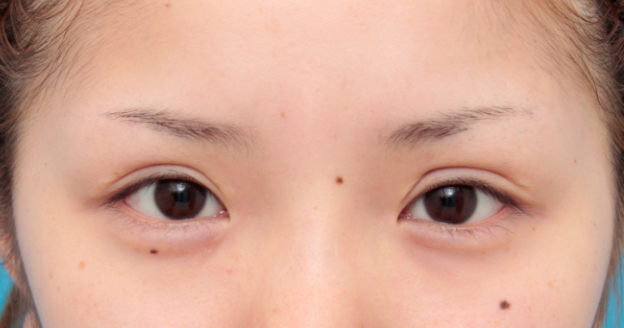 症例写真,目頭切開で目を内側に大きくし平行型二重を際立たせた症例写真,手術前,mainpic_megashira31a.jpg