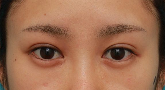 症例写真,目頭切開+目尻切開で目の横幅を内側と外側に広げた20代女性の症例写真,After（メイクなし）,ba_megashira33_b.jpg