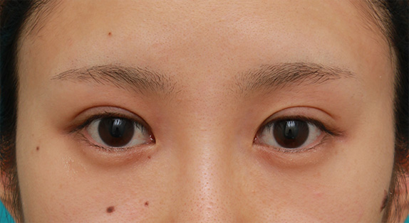 症例写真,目頭切開+目尻切開で目の横幅を内側と外側に広げた20代女性の症例写真,Before,ba_megashira33_b.jpg