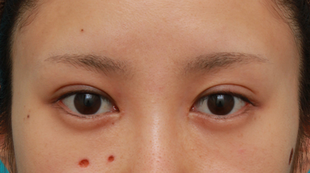 症例写真,目頭切開+目尻切開で目の横幅を内側と外側に広げた20代女性の症例写真,1ヶ月後,mainpic_megashira32d.jpg
