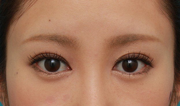 症例写真,目頭切開+目尻切開で目の横幅を内側と外側に広げた20代女性の症例写真,4ヶ月後,メイクあり,mainpic_megashira32f.jpg