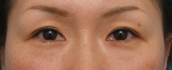 目尻切開 30代女性、術後1ヶ月の症例写真,Before,ba_mejiri01_b.jpg