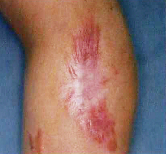 症例写真,傷跡の症例写真　Vビームによる治療,Before,ba_keisei09_b.jpg