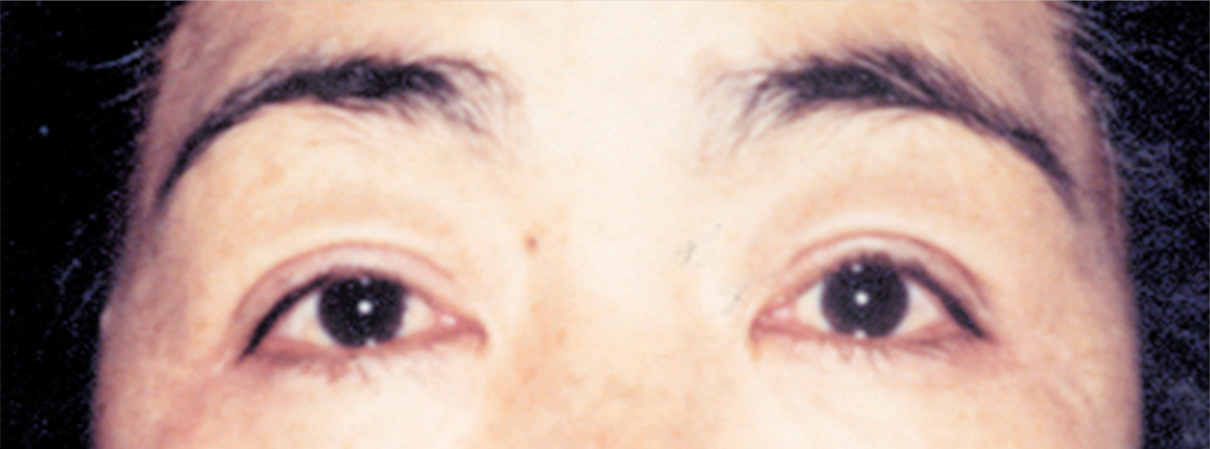 眼瞼下垂（がんけんかすい） まぶたが目にかぶさり片目はほとんど開いていない症例,After,ba_ganken17_a01.jpg