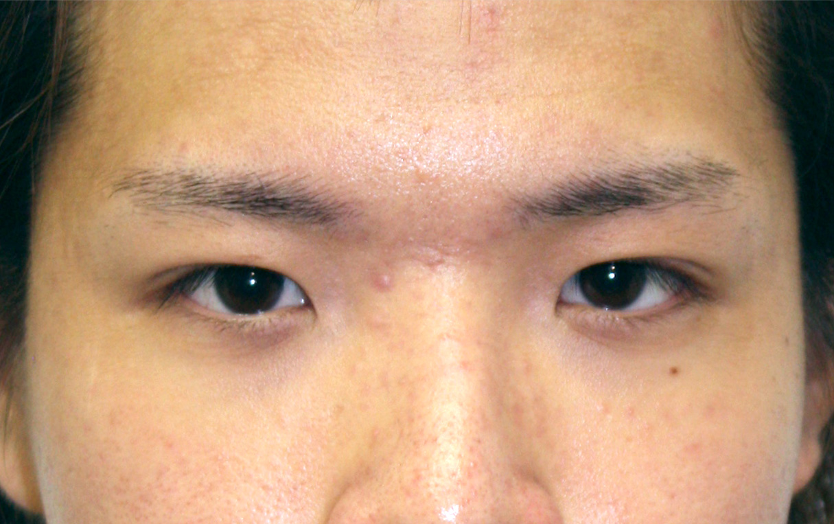 眼瞼下垂（がんけんかすい） まぶたが下がり老けてみえがちな男性の症例,After（1ヶ月後）,ba_ganken21_a01.jpg