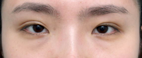 他院で受けた手術の修正（二重まぶた・目もと）,眼瞼下垂（がんけんかすい） 他院施術の修正手術症例,Before,ba_ganken23_b.jpg
