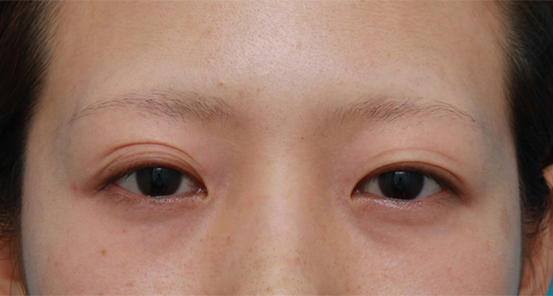 症例写真,患者様の希望でかなり幅の広い平行型二重を作った症例写真,手術前,mainpic_sekkai26a.jpg