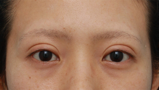 症例写真,患者様の希望でかなり幅の広い平行型二重を作った症例写真,6ヶ月後,mainpic_sekkai26e.jpg