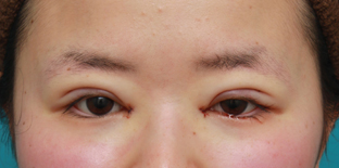 症例写真,目頭切開+二重まぶた全切開法で、大きく印象を変えずに目をぱっちりさせた症例写真の術前術後画像,手術直後,mainpic_sekkai29b.jpg