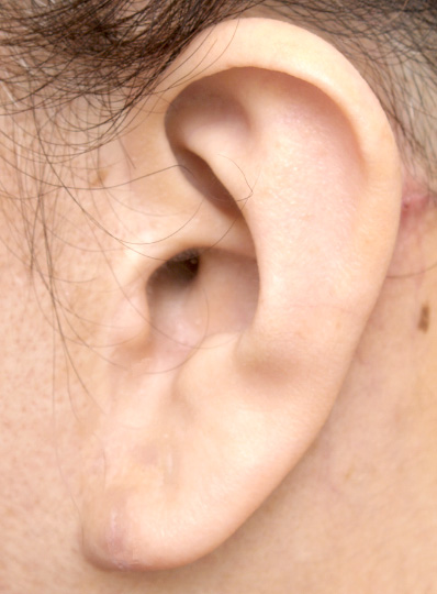 症例写真,傷跡　耳たぶのピアス裂傷を手術で修正,After,ba_mimiother04_b.jpg