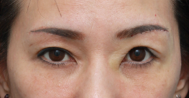 症例写真,片目ずつ眉下リフト（上眼瞼リフト）した症例写真,左側手術直後,mainpic_tarumi02e.jpg