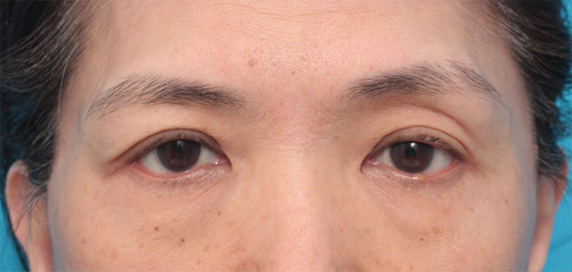 症例写真,片目の上まぶたたるみ取り手術をして二重を作り、左右差を修正した症例写真,After（2ヶ月後）,ba_tarumi23_b.jpg