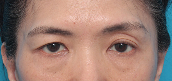 症例写真,片目の上まぶたたるみ取り手術をして二重を作り、左右差を修正した症例写真,Before,ba_tarumi23_b.jpg
