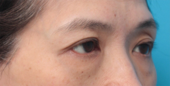 症例写真,片目の上まぶたたるみ取り手術をして二重を作り、左右差を修正した症例写真,After（2ヶ月後）,ba_tarumi24_b.jpg