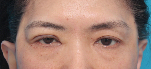 症例写真,片目の上まぶたたるみ取り手術をして二重を作り、左右差を修正した症例写真,手術直後,mainpic_tarumi03b.jpg