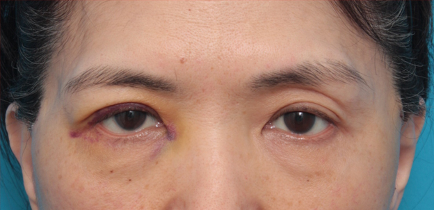 症例写真,片目の上まぶたたるみ取り手術をして二重を作り、左右差を修正した症例写真,1週間後,mainpic_tarumi03c.jpg