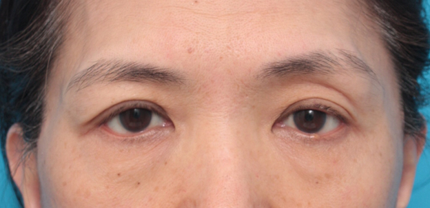 症例写真,片目の上まぶたたるみ取り手術をして二重を作り、左右差を修正した症例写真,2ヶ月後,mainpic_tarumi03d.jpg