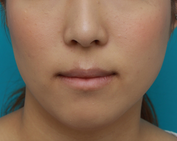 症例写真,下唇のみを手術で薄くして、バランスを整えた症例写真,3ヶ月後,mainpic_usuku03d.jpg