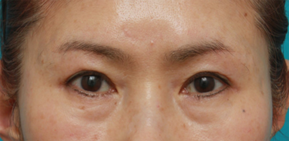 症例写真,眉下リフト（上眼瞼リフト）の症例写真,After（6ヶ月後）,ba_tarumi25_b.jpg