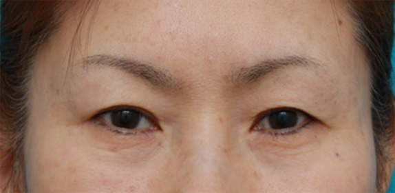 眉下リフト（上眼瞼リフト）の症例写真,Before,ba_tarumi25_b.jpg