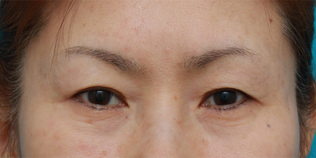 症例写真,眉下リフト（上眼瞼リフト）の症例写真,手術前,mainpic_tarumi04a.jpg