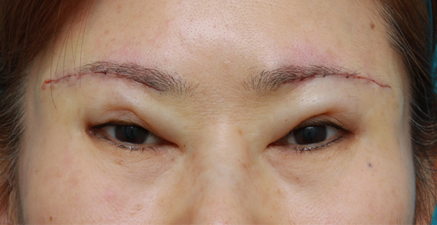 症例写真,眉下リフト（上眼瞼リフト）の症例写真,手術直後,mainpic_tarumi04b.jpg