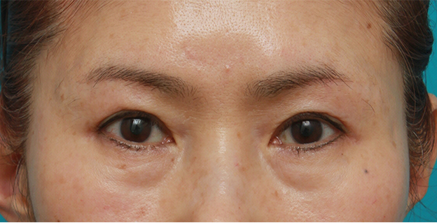 症例写真,眉下リフト（上眼瞼リフト）の症例写真,6ヶ月後,mainpic_tarumi04d.jpg