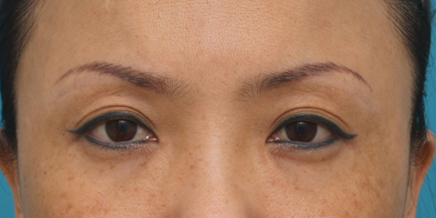 症例写真,眉下リフト（上眼瞼リフト）で目を大きくして二重の幅を広げた中国人女性の症例写真の術前術後画像,手術前,mainpic_jougankenlift02a.jpg