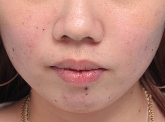 症例写真,タラコ唇の人に、手術で上下の唇を薄くした症例写真,Before,ba_usuku12_b.jpg