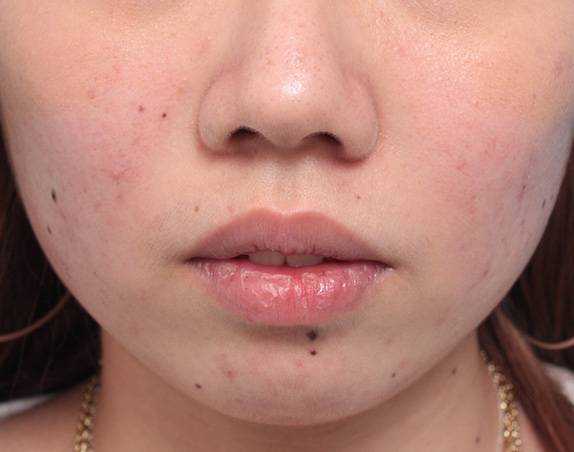 症例写真,タラコ唇の人に、手術で上下の唇を薄くした症例写真,Before,ba_usuku13_b.jpg