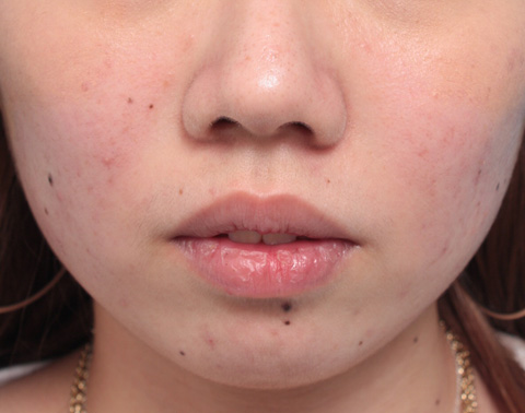 症例写真,タラコ唇の人に、手術で上下の唇を薄くした症例写真,手術前,mainpic_usuku02a.jpg