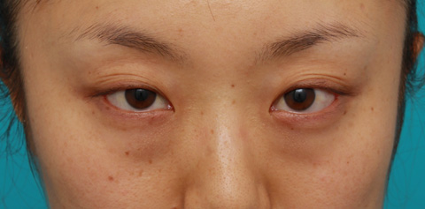 症例写真,目の下の脂肪取り症例写真,施術前,mainpic_shibo02a.jpg