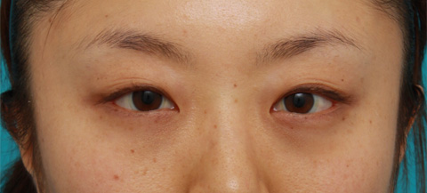 症例写真,目の下の脂肪取り症例写真,1ヶ月後,mainpic_shibo04a.jpg