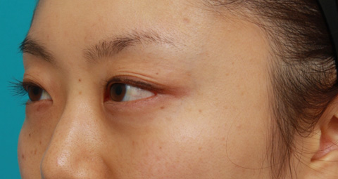症例写真,目の下の脂肪取り症例写真,1ヶ月後,mainpic_shibo04b.jpg