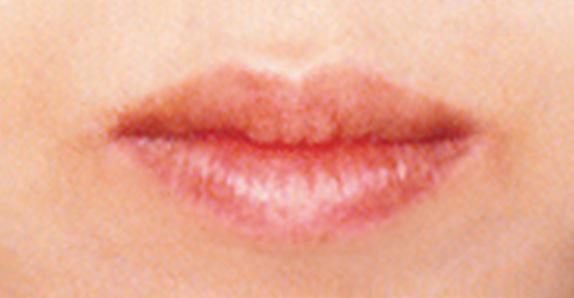 症例写真,唇を薄く（口唇縮小術）の症例　下唇のみ施術,After,ba_usuku09_b.jpg