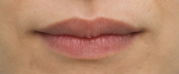 唇を薄く（口唇縮小術）の症例 上唇、下唇をそれぞれ薄くした30代女性,Before,ba_usuku07_b.jpg
