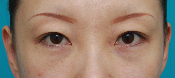 目の下の脂肪取り,目の下のクマ治療,目の下のクマに対して脂肪除去をした症例写真,After（メイクなし）,ba_tarumi19a_a01.jpg
